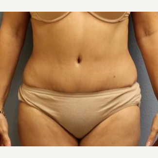 45-54 year old woman treated with Liposuction before 3726463