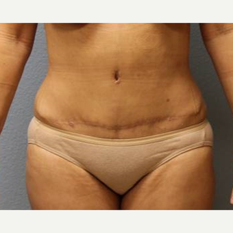 45-54 year old woman treated with Liposuction after 3726463