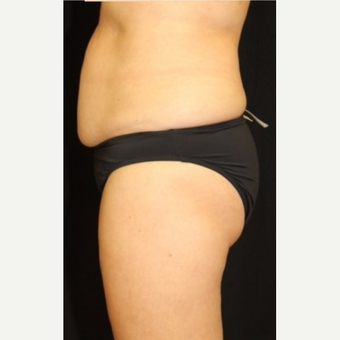 52 year old woman treated with CoolSculpting Non-Surgical Fat Reduction after 3702255