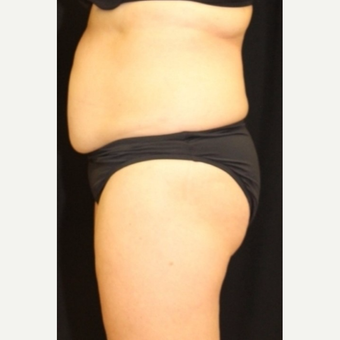 52 year old woman treated with CoolSculpting Non-Surgical Fat Reduction before 3702255