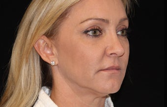 45-54 year old woman treated with Liquid Facelift 3503047