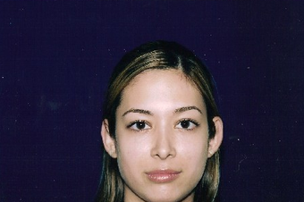 Rhinoplasty after 229773