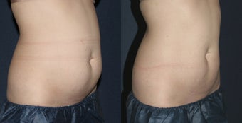 Before & After CoolSculpting before 1027805