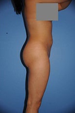 Butt Implants after 1044752