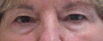 Before and after upper and lower eyelid surgery before 3423159
