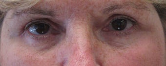 Before and after upper and lower eyelid surgery after 3423159