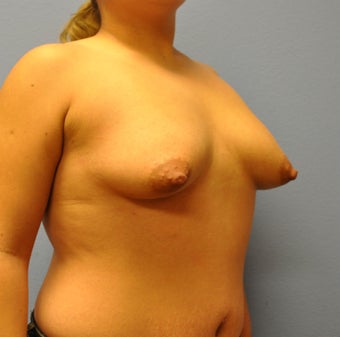 Mastopexy, Breast Lift 1162076