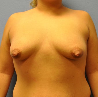 Mastopexy, Breast Lift before 1162076