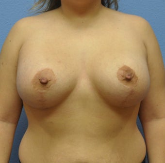 Mastopexy, Breast Lift after 1162076
