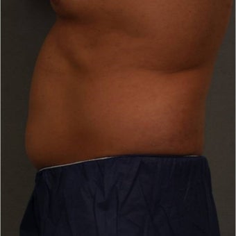 35-44 year old man treated with CoolSculpting of the lower abdomen Newburgh, New York after 1683228