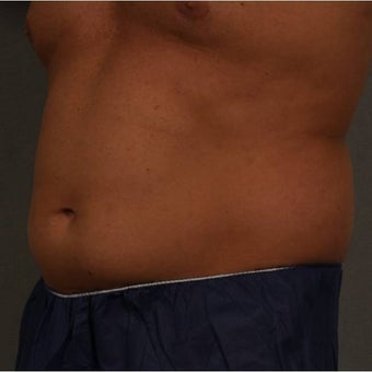 35-44 year old man treated with CoolSculpting of the lower abdomen Newburgh, New York 1683228
