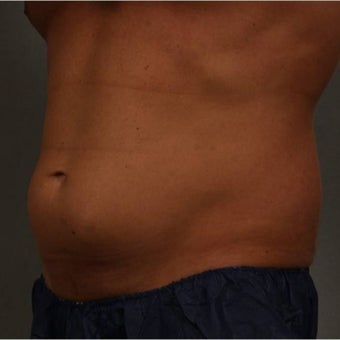 35-44 year old man treated with CoolSculpting of the lower abdomen Newburgh, New York 1683228