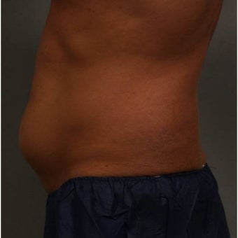 35-44 year old man treated with CoolSculpting of the lower abdomen Newburgh, New York before 1683228