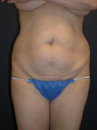 tummy tuck with waist liposuction before 407304