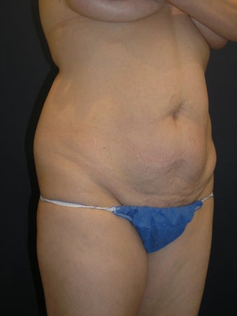tummy tuck with waist liposuction 407304