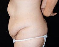 Liposuction of Abs & Hips before 849550