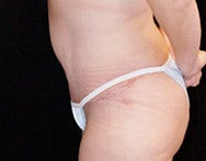 Liposuction of Abs & Hips after 849550
