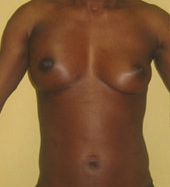 Brest Reconstruction With Natural Fat after 390381