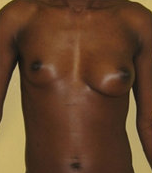 Brest Reconstruction With Natural Fat before 390381