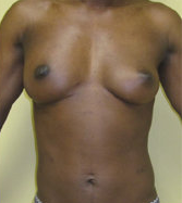 Brest Reconstruction With Natural Fat 390381