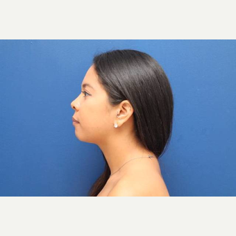 28 year old female treated with 2 sessions of Kybella (4 total vials) after 3814782