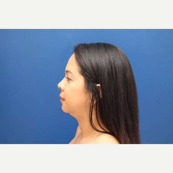 28 year old female treated with 2 sessions of Kybella (4 total vials) before 3814782