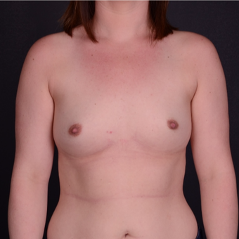 25-34 year old woman treated with Breast Implants before 3738135