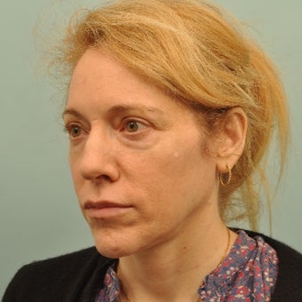 45-54 year old woman treated with Liquid Facelift before 2202507