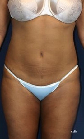45-54 year old woman treated with Liposuction after 1683530