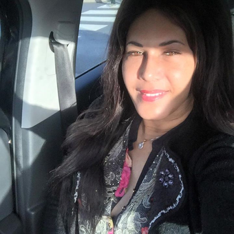 25-34 year old woman treated with MTF Facial Feminization Surgery after 3263630