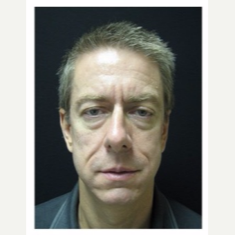 45-54 year old man treated with Non Surgical Face Lift before 3180988