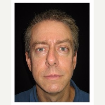45-54 year old man treated with Non Surgical Face Lift after 3180988