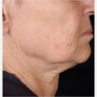 Female with chin laxity treated with TITAN laser before 3175485