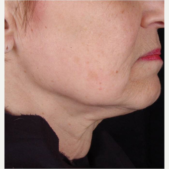 Female with chin laxity treated with TITAN laser after 3175485