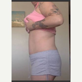 25-34 year old woman treated with Tummy Tuck after 3815669