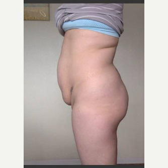 25-34 year old woman treated with Tummy Tuck before 3815669