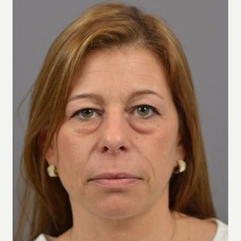 35-44 year old woman treated with Eyelid Surgery, Fat Grafting and TCA Chemical Peel before 3060746