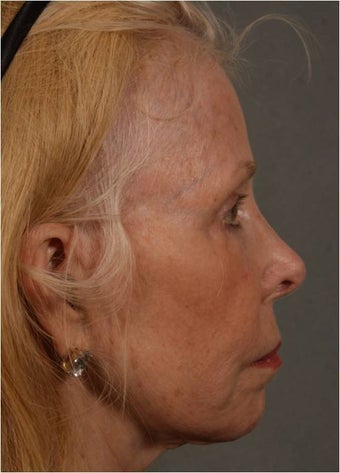 73 Year Old after facial volume restoration & lifting with Juvederm Voluma 1348117