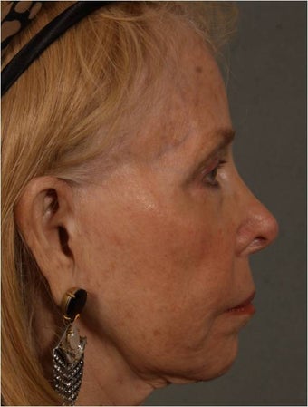 73 Year Old after facial volume restoration & lifting with Juvederm Voluma 1348117
