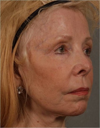 73 Year Old after facial volume restoration & lifting with Juvederm Voluma after 1348117