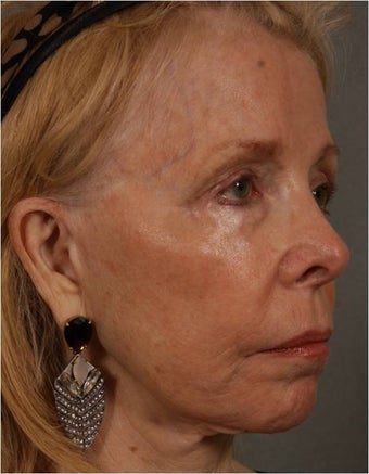 73 Year Old after facial volume restoration & lifting with Juvederm Voluma before 1348117