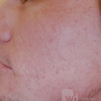 TCA CROSS and CO2 Laser - fractional laser over months after 3444449