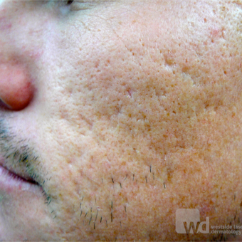 TCA CROSS and CO2 Laser - fractional laser over months before 3444449