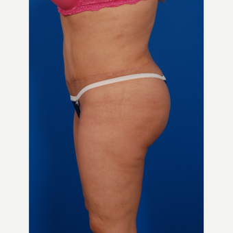 35-44 year old woman treated with Brazilian Butt Lift after 3576851