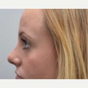 18-24 year old woman treated with Rhinoplasty after 3747741