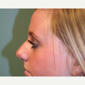 18-24 year old woman treated with Rhinoplasty before 3747741