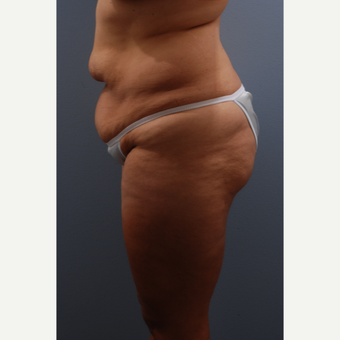 35-44 year old woman treated with Tummy Tuck before 3584085