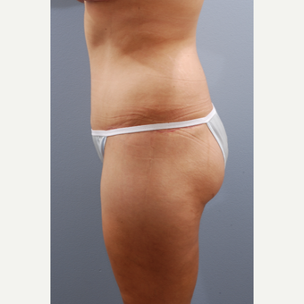 35-44 year old woman treated with Tummy Tuck after 3584085