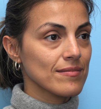 Eye Dermafillers, Cheek Dermafillers, Facial Dermafillers 454584