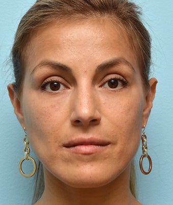 Eye Dermafillers, Cheek Dermafillers, Facial Dermafillers after 454584